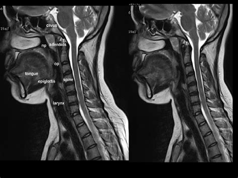 Does Cervical MRI Show Throat Cancer?